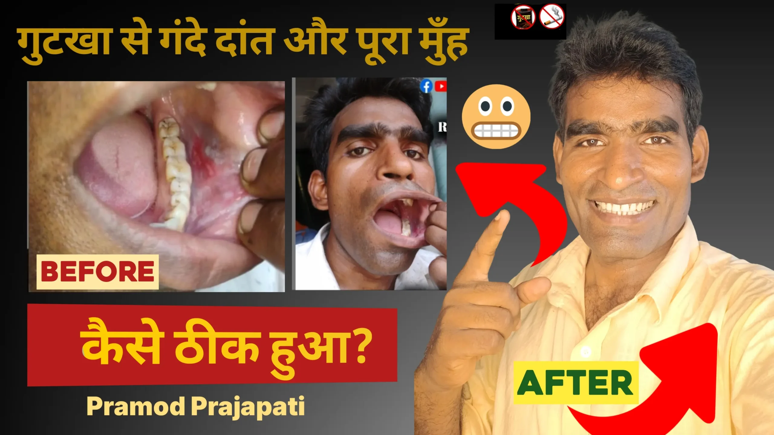 Gutakha khane se kharab daant aur pura Munh kaise thiek kare?